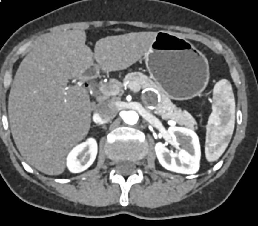 Calcified Rim to a Pancreatic Cyst - CTisus CT Scan
