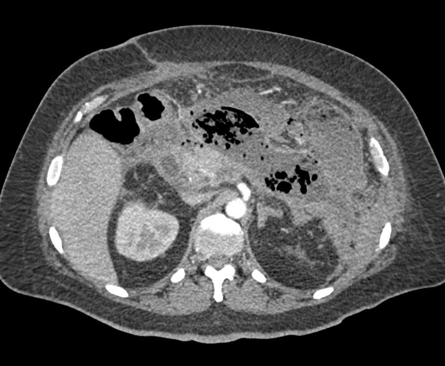 Pancreatic Necrosis and Abscess - CTisus CT Scan