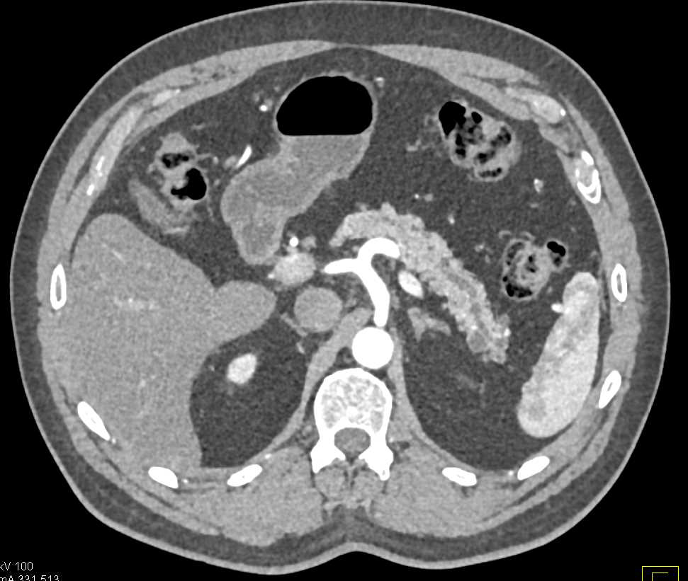 Lipoma Head of Pancreas and Intraductal Papillary Mucinous Neoplasms (IPMNs) - CTisus CT Scan