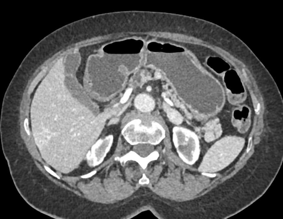 Multiple Intraductal Papillary Mucinous Neoplasms (IPMNs) - CTisus CT Scan