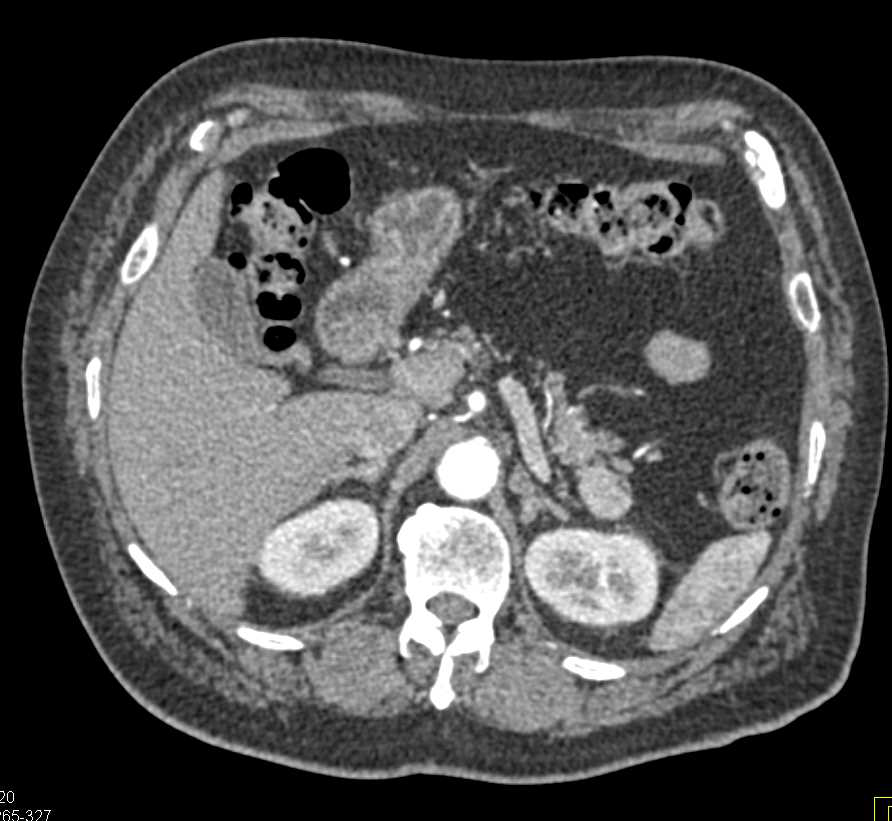 Accessory Spleen Simulates a Pancreatic Mass - CTisus CT Scan