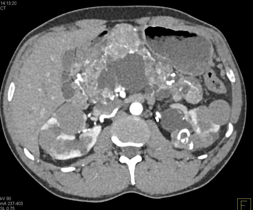 Von Hippel-Lindau Syndrome (VHL) with Multiple Renal Cell Carcinomas and Multiple Pancreatic Neuroendocrine Tumors (PNETs) - CTisus CT Scan