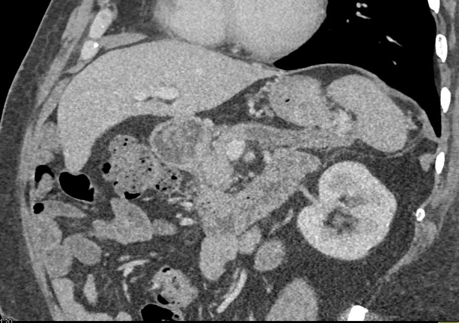 Dilated Pancreatic Duct - CTisus CT Scan