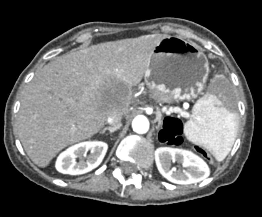 Pancreatic Adenocarcinoma with Liver Metastases and Splenic Infarcts and Pulmonary Embolism (PE) and Left Femoral Vein Thrombosis - CTisus CT Scan