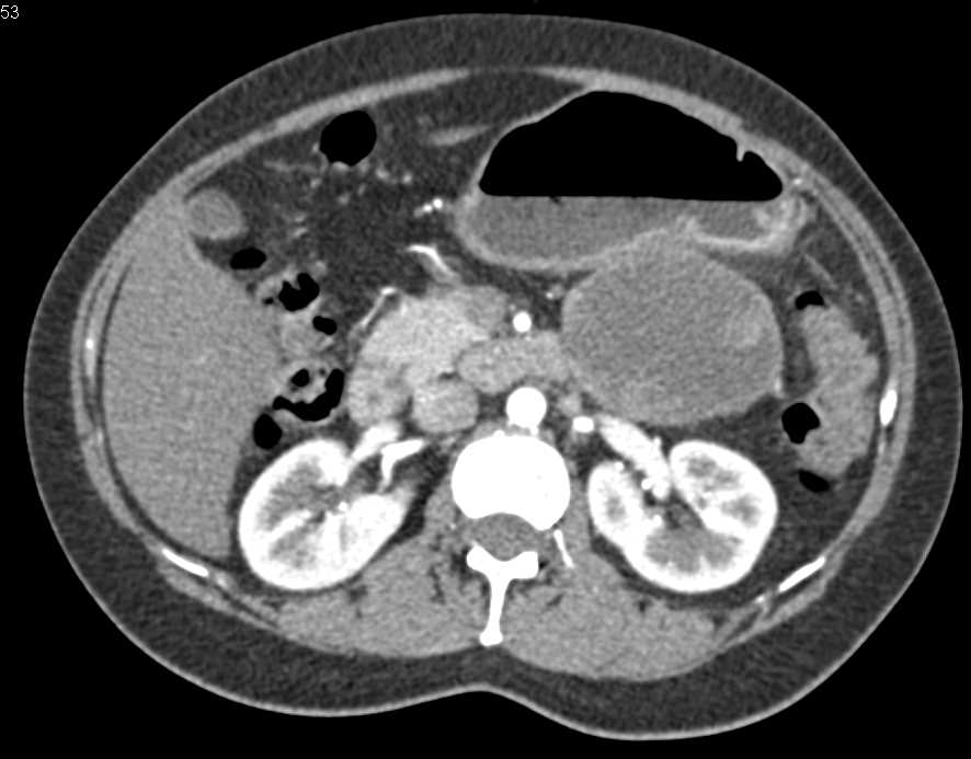 Cystic Pancreatic Neuroendocrine Tumor (PNET) Tumor Tail of the Pancreas - CTisus CT Scan