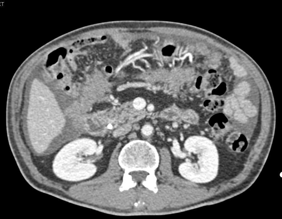 Carcinoma of the Tail of the Pancreas with Carcinomatosis - CTisus CT Scan