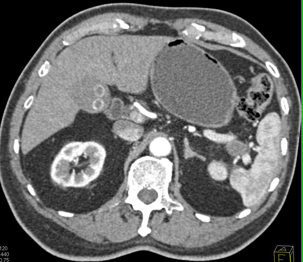 Carcinoma Tail of the Pancreas - CTisus CT Scan