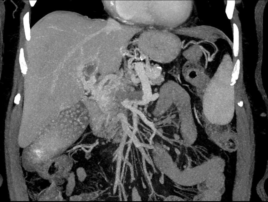 Pancreatic Cancer with Vascular Encasement - CTisus CT Scan