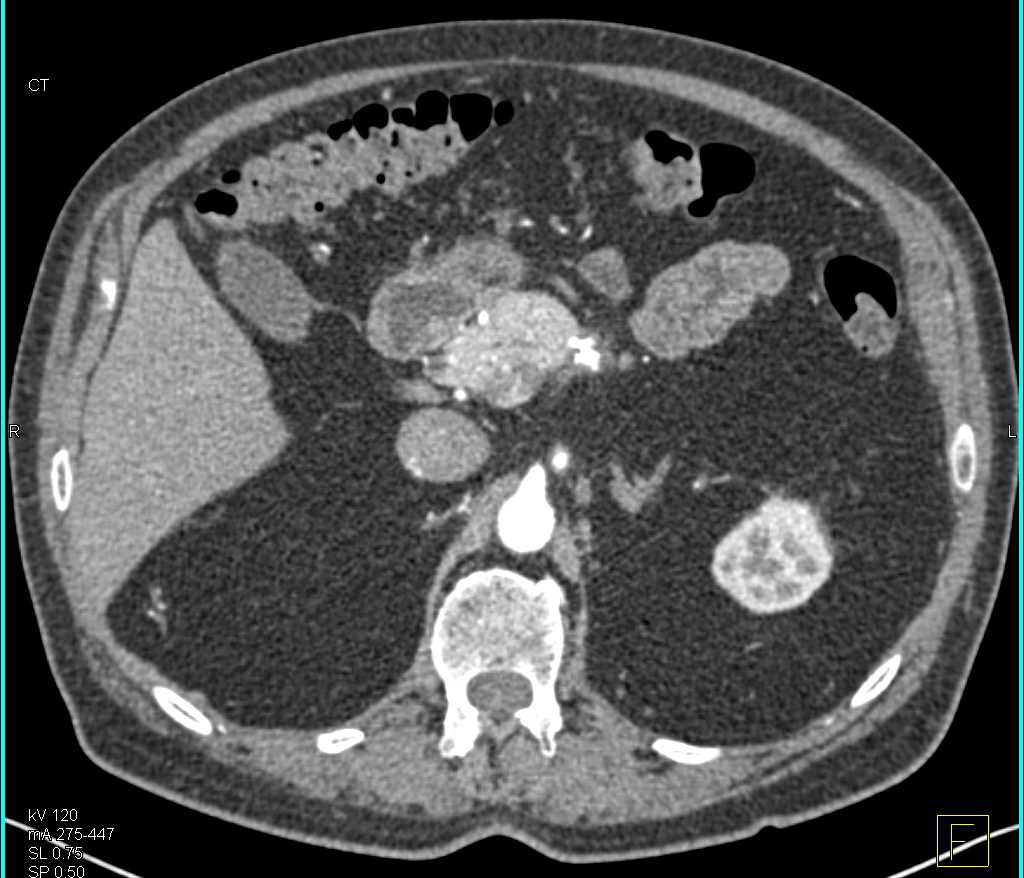 Neuroendocrine Tumor in the Head of the Pancreas - CTisus CT Scan