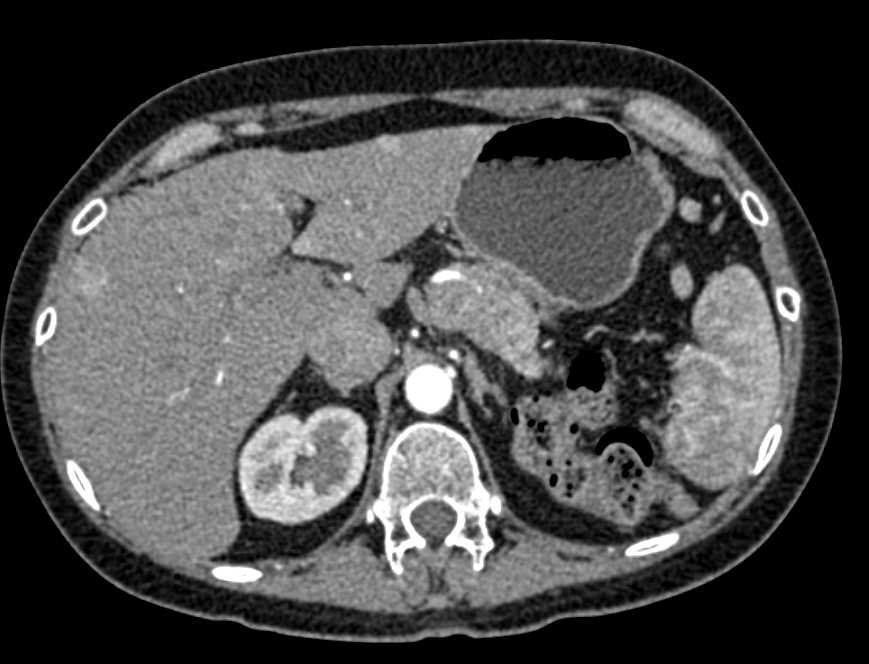 Neuroendocrine Tumor Pancreas with Liver Metastases - CTisus CT Scan