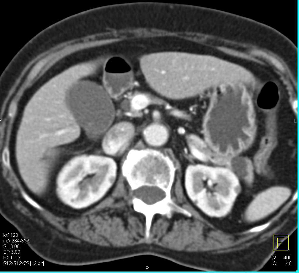 Top Normal Pancreatic Duct - CTisus CT Scan
