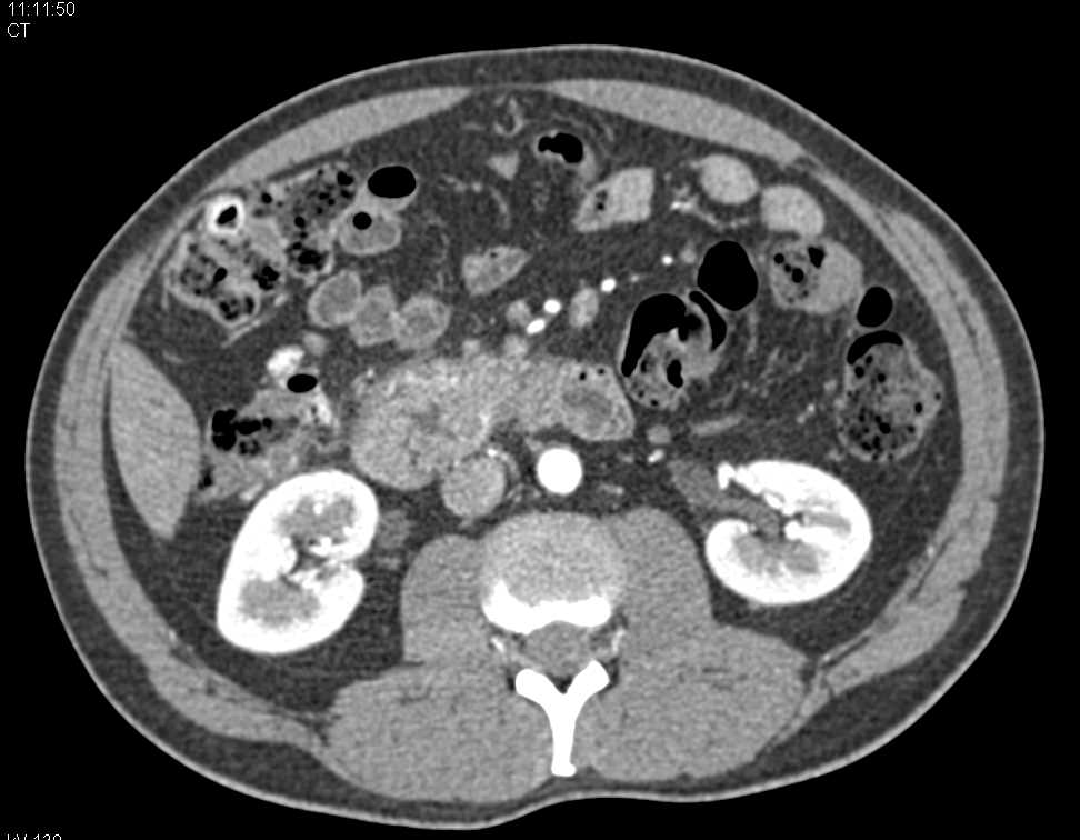 Ampullary Cancer with a Double Duct Sign - CTisus CT Scan