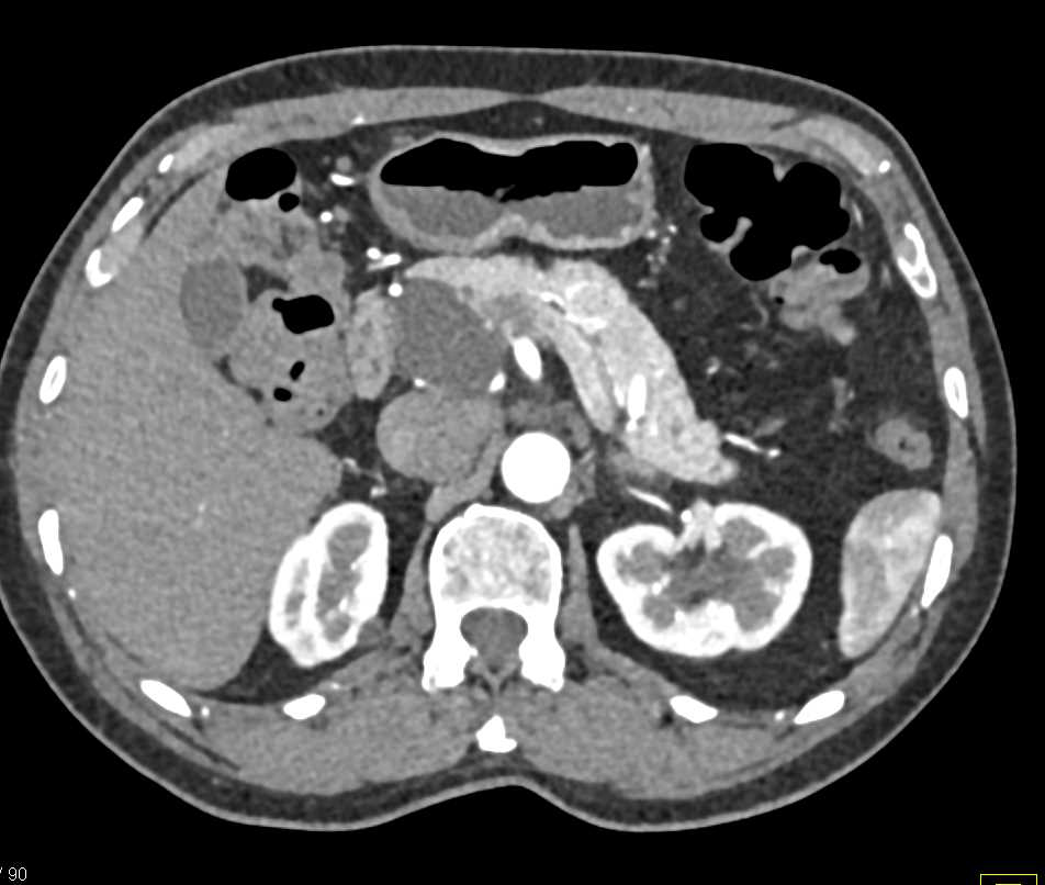 Serous Cystadenoma - CTisus CT Scan