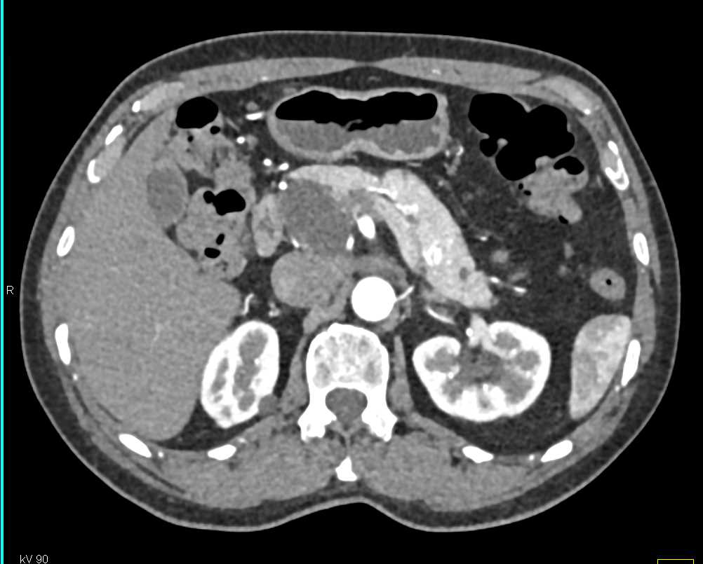 Serous Cystadenoma - CTisus CT Scan
