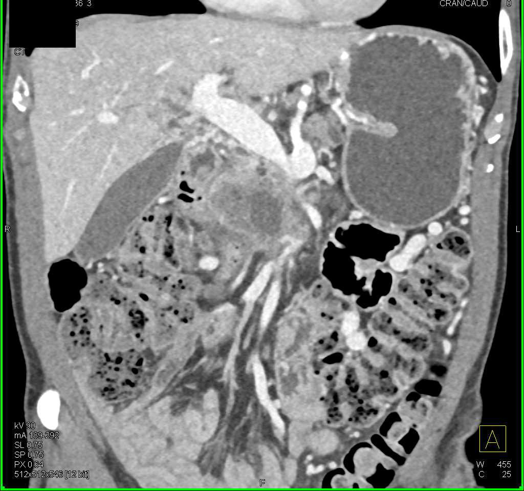Pancreatic Adenocarcinoma with Liver Metastases - CTisus CT Scan