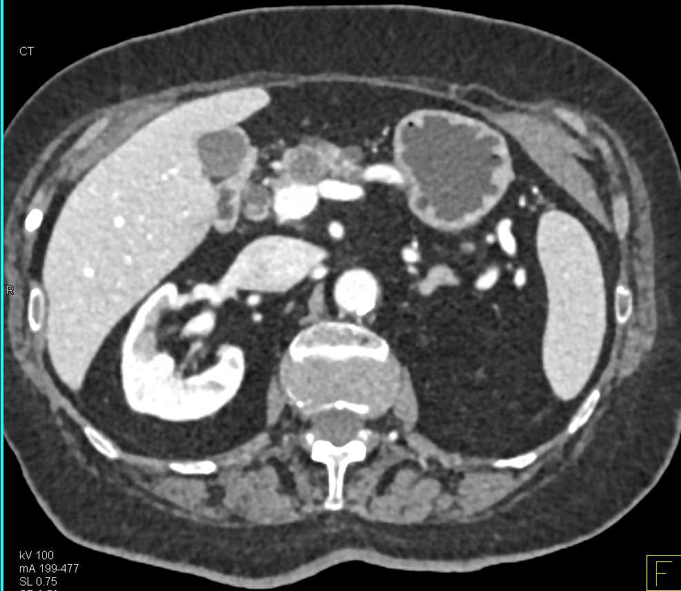 Multiple Intraductal Papillary Mucinous Neoplasms (IPMNs) - CTisus CT Scan