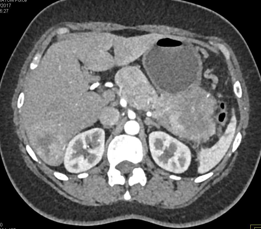 Carcinoma Tail of Pancreas with Liver Metastases - CTisus CT Scan