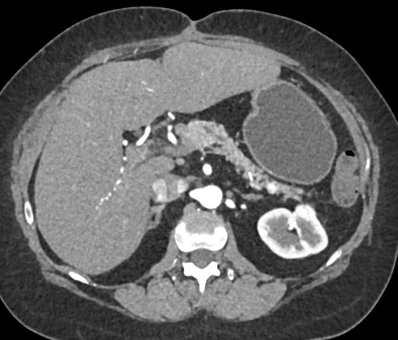 Metastases to the Tail of the Pancreas - CTisus CT Scan