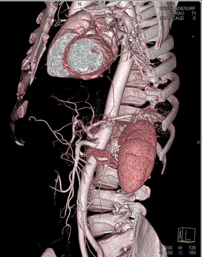 Normal 3D Pancreas - CTisus CT Scan