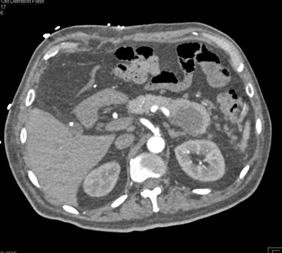 Intraductal Papillary Mucinous Neoplasm (IPMN) Tail of Pancreas - CTisus CT Scan