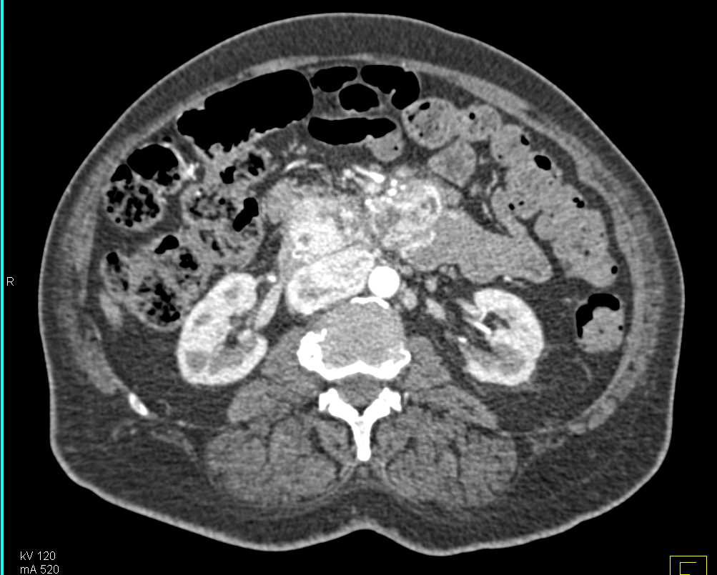 Neuroendocrine Tumor of the Pancreas with Liver Metastases - CTisus CT Scan