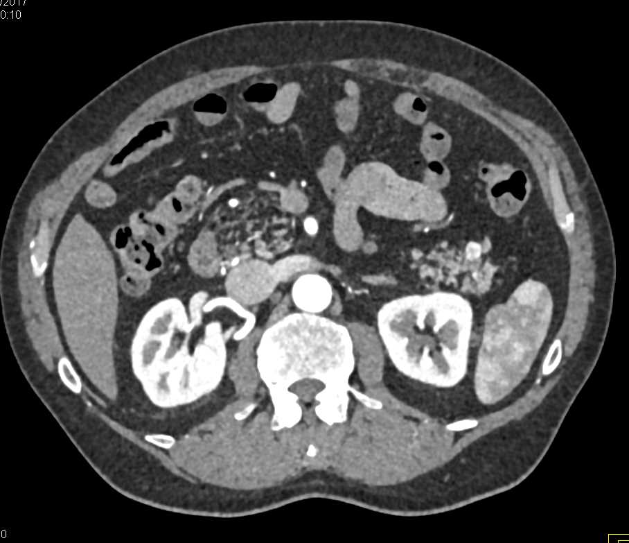 Pancreatic Neuroendocrine Tumor (PNET) Tail of Pancreas - CTisus CT Scan