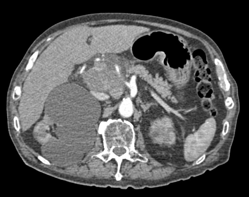 Adenocarcinoma of the Head of the Pancreas - CTisus CT Scan