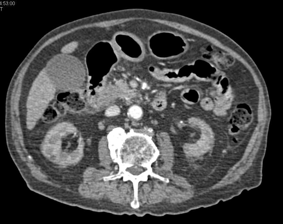 Carcinoma of the Head of the Pancreas - CTisus CT Scan