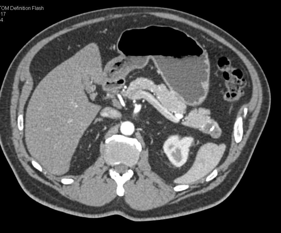 Intraductal Papillary Mucinous Neoplasm (IPMN) Tail of the Pancreas - CTisus CT Scan