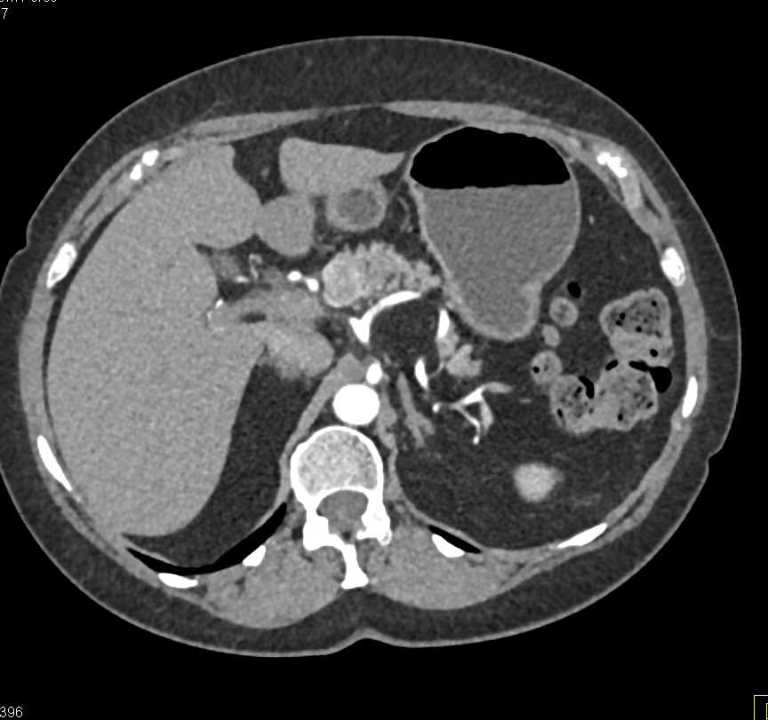 Neuroendocrine Tumor Head of the Pancreas - CTisus CT Scan