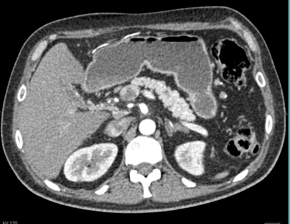 Adenocarcinoma of the Body of the Pancreas with Vascular Encasement - CTisus CT Scan
