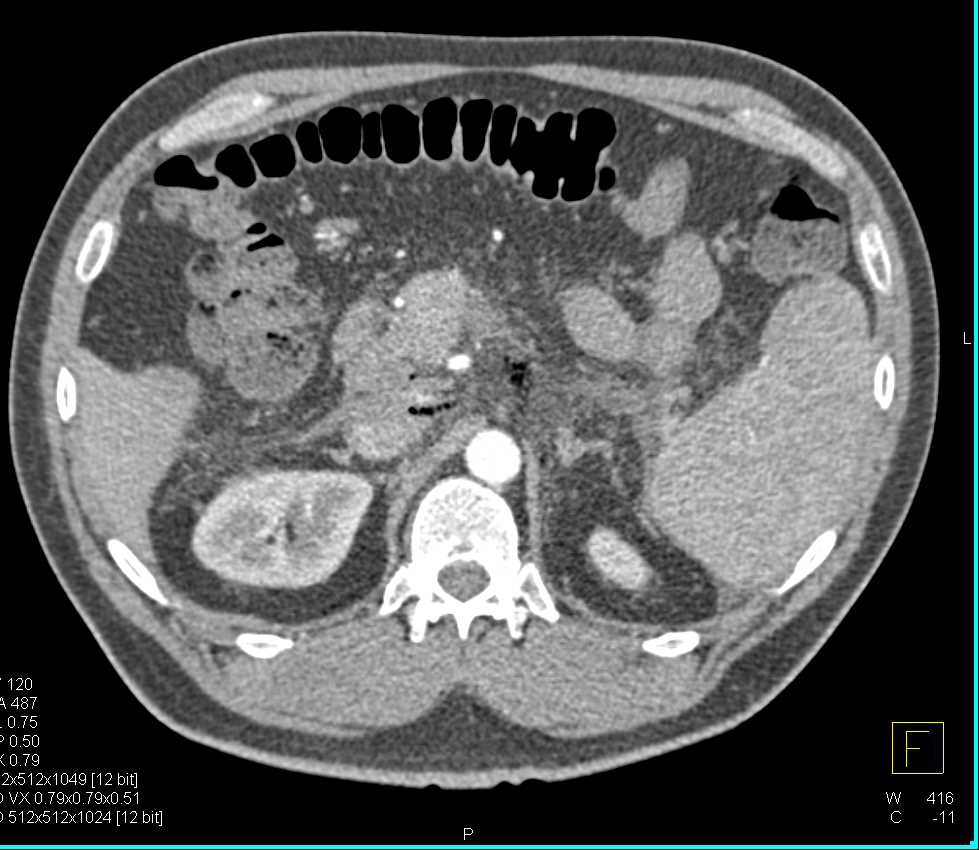 Air in Retroperitoneum S/P Endoscopic Retrograde Cholangiopancreatography (ERCP) - CTisus CT Scan