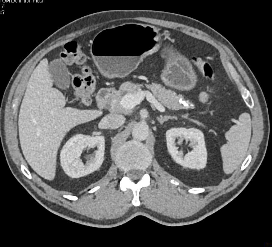 Neuroendocrine Tumor in the Tail of the Pancreas - CTisus CT Scan