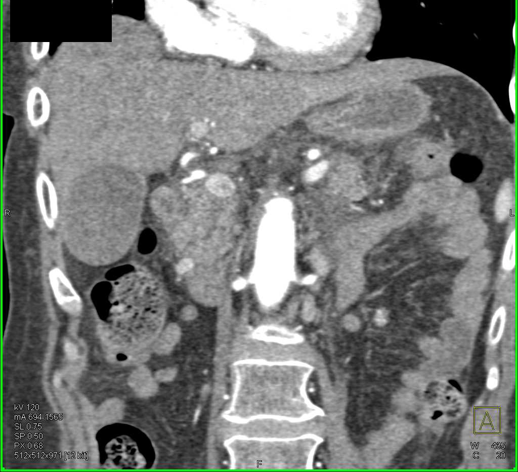 Neuroendocrine Tumors of the Pancreas - CTisus CT Scan