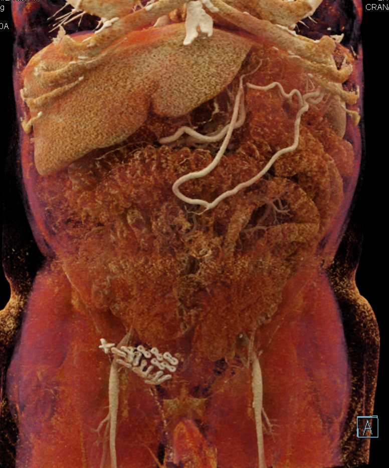 Pancreatic Adenocarcinoma with Vascular Invasion in Cinematic Rendering - CTisus CT Scan