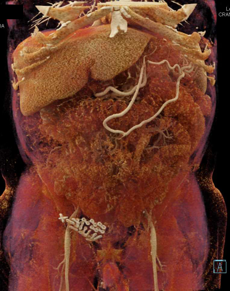 Pancreas Adenocarcinoma with Vessel Encasement Especially PV/SMV with Cinematic Rendering - CTisus CT Scan