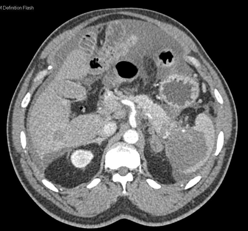 Carcinoma Tail of Pancreas Invades the Spleen and Carcinomatosis - CTisus CT Scan