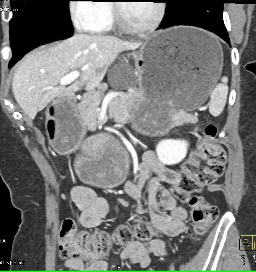 Pancreas Adenocarcinoma - CTisus CT Scan