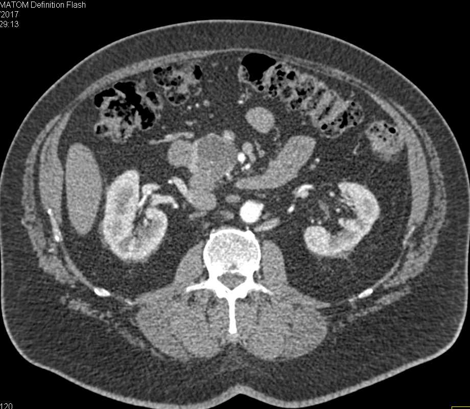 Intraductal Papillary Mucinous Neoplasm (IPMN) Head of Pancreas - CTisus CT Scan