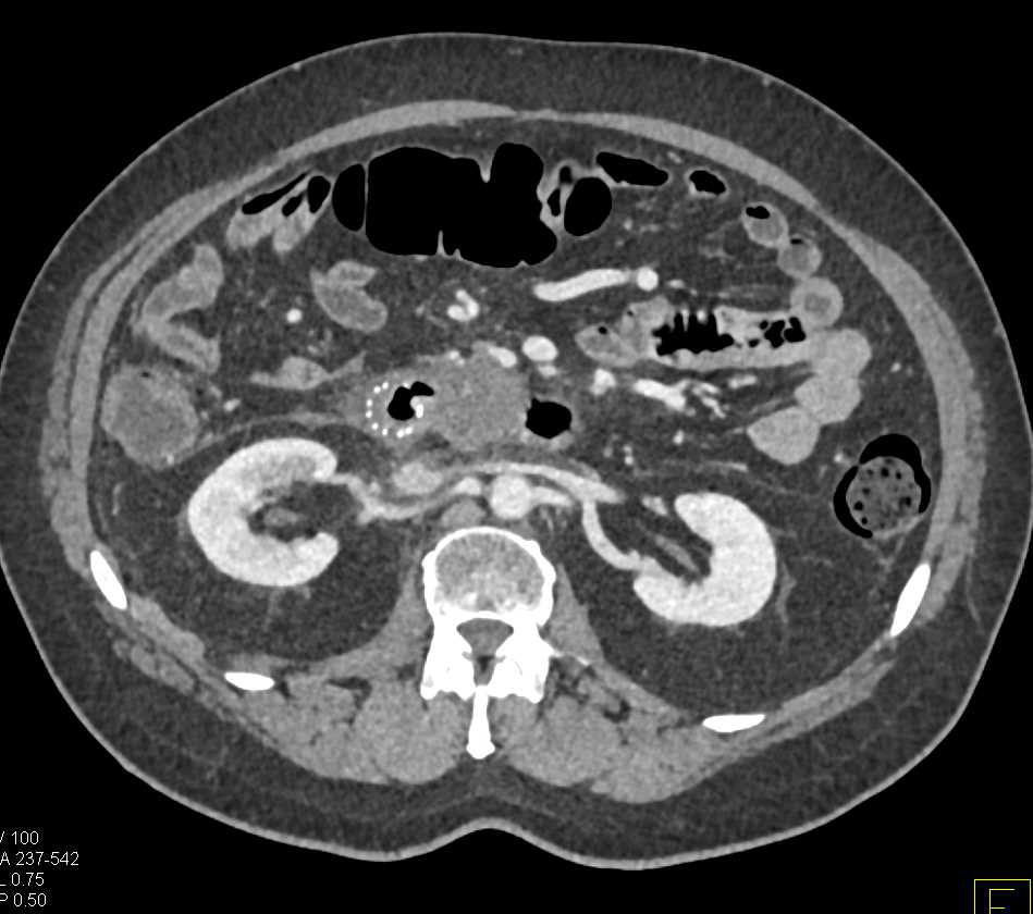 Pancreatic Cancer Invades the Duodenum - CTisus CT Scan