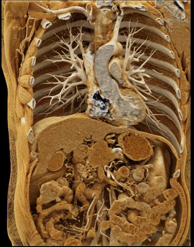 Pancreatic Cancer with Normal Vessels with Cinematic Rendering - CTisus CT Scan