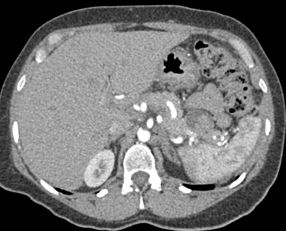 Solid and Papillary Epithelial Neoplasm (SPEN) Tail of Pancreas - CTisus CT Scan
