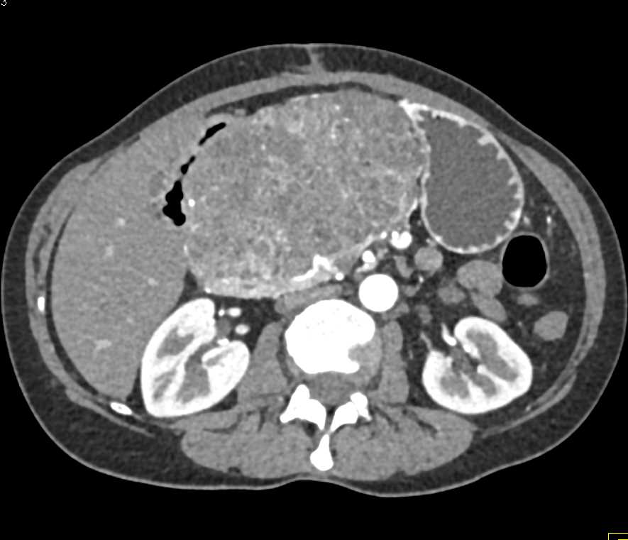 Cystadenocarcinoma of the Pancreas - CTisus CT Scan