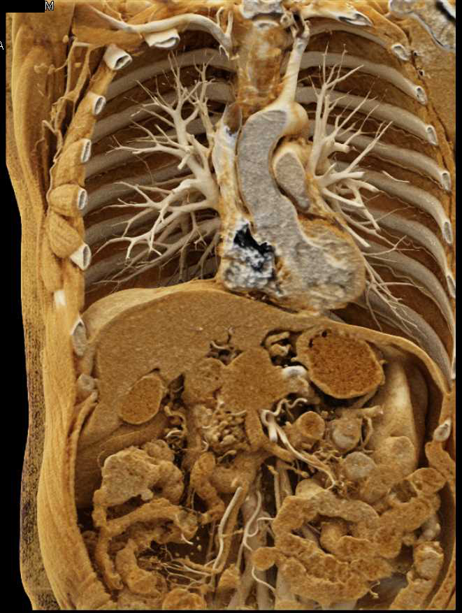 Carcinoma of the Pancreas with Cinematic Rendering - CTisus CT Scan