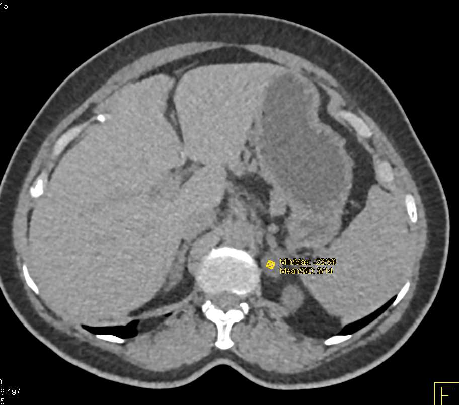 8mm Pancreatic Neuroendocrine Tumor (PNET) Tail of the Pancreas - CTisus CT Scan
