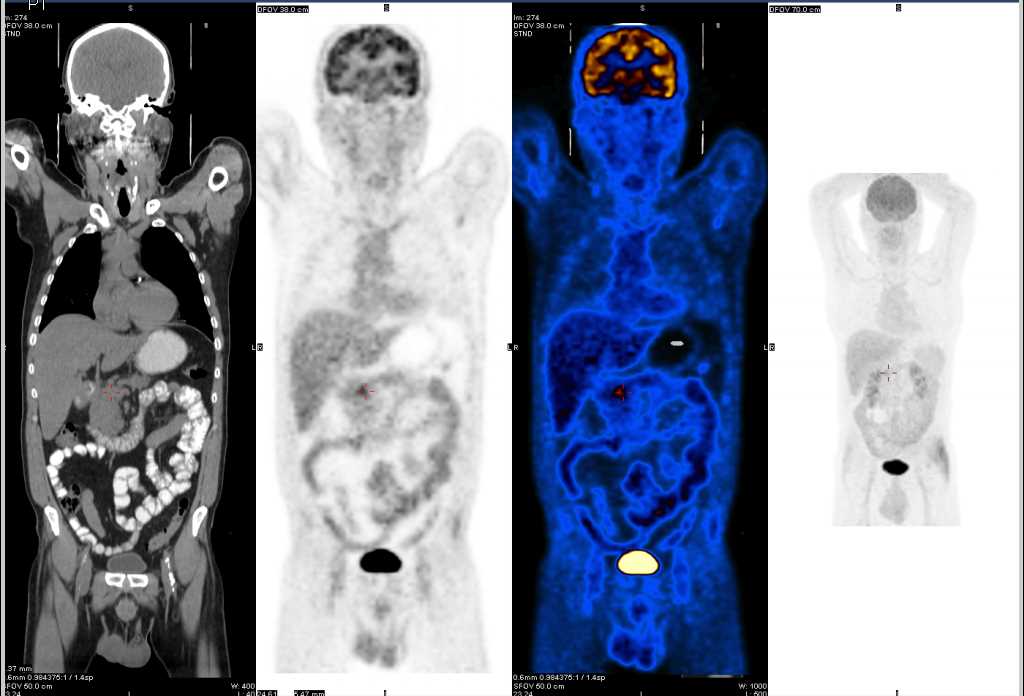 Carcinoma Head of Pancreas - CTisus CT Scan