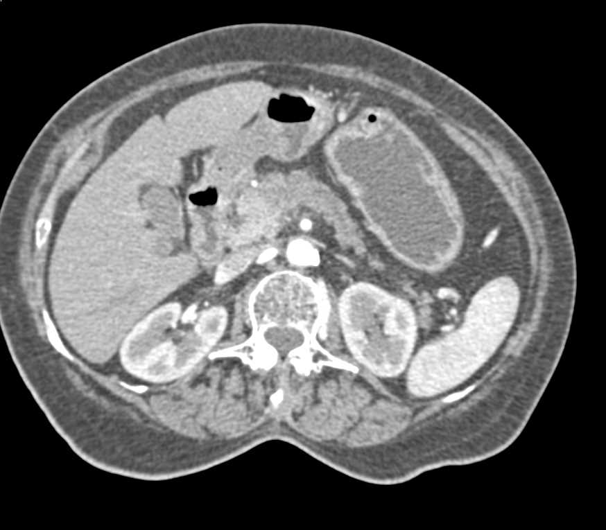 Carcinoma Body of the Pancreas with Dilated Pancreatic Duct and Vascular Encasement - CTisus CT Scan