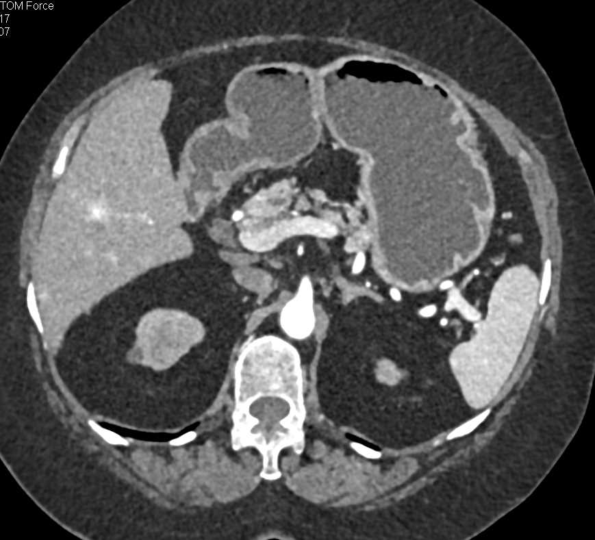 Serous Cystadenoma Head of Pancreas - CTisus CT Scan