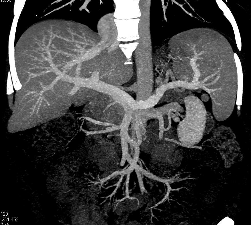 Carcinoma Body of the Pancreas - CTisus CT Scan