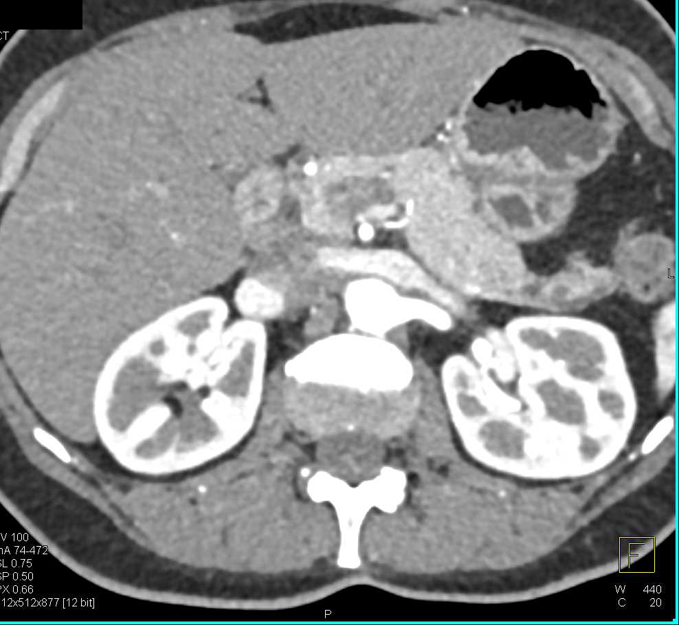 Carcinoma Tail of Pancreas with Dilated Pancreatic Duct - CTisus CT Scan